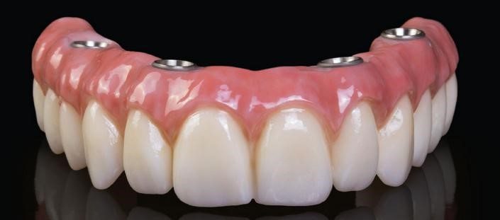 Trồng răng Implant toàn hàm all on 4, all on 6