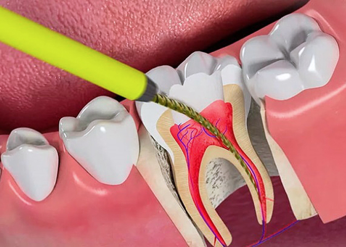 Điều trị tuỷ mấy lần