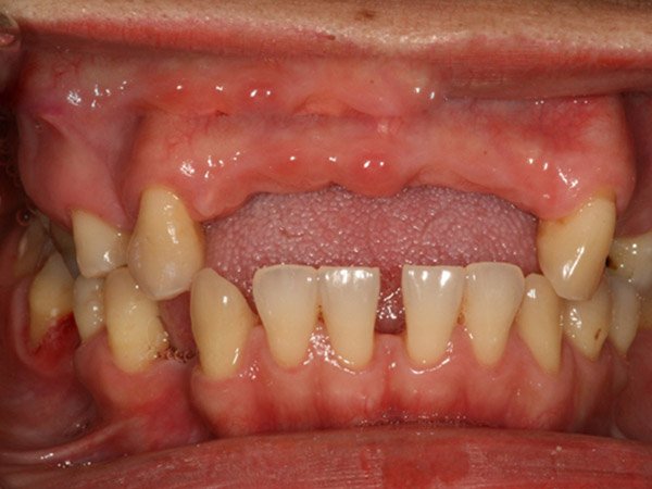 Tiêu xương hàm điều trị thế nào? Phương pháp và chi phí 9 Điều trị tiêu xương hàm