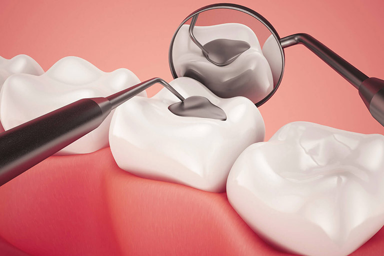 Mẹ bầu trám răng được không? Lưu ý khi trám răng là gì? 4 Mẹ bầu trám răng được không? Lưu ý khi trám răng là gì?
