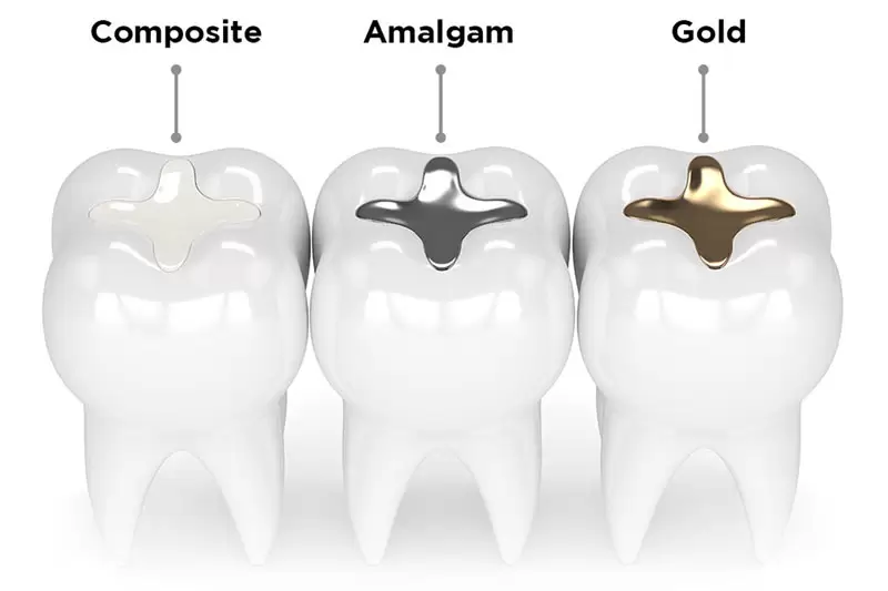 Mẹ bầu trám răng được không? Lưu ý khi trám răng là gì? 6 Mẹ bầu trám răng được không? Lưu ý khi trám răng là gì?