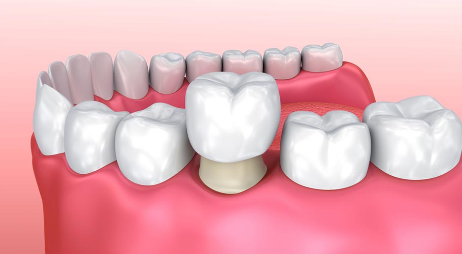 Răng bị gãy nứt: Nguyên nhân, triệu chứng, điều trị và phòng tránh