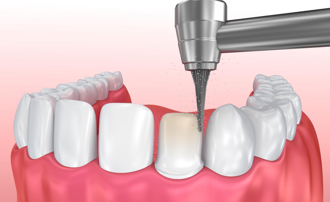 Bọc răng sứ bị cộm do đâu? Dấu hiệu nhận biết và cách khắc phục 5 Bọc răng sứ bị cộm do đâu? Dấu hiệu nhận biết và cách khắc phục