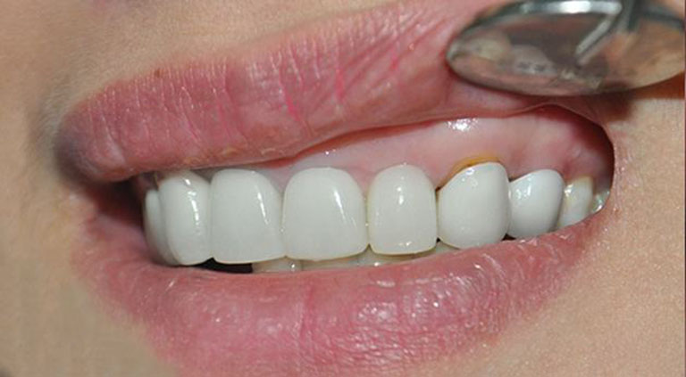 Bọc răng sứ bị cộm do đâu? Dấu hiệu nhận biết và cách khắc phục 6 Bọc răng sứ bị cộm do đâu? Dấu hiệu nhận biết và cách khắc phục