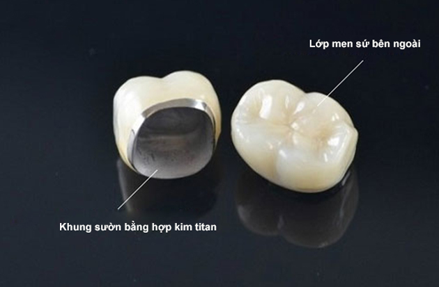 Cuộc đối đầu giữa Răng sứ kim loại và Răng sứ Titan