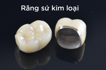 Cuộc đối đầu giữa Răng sứ kim loại và Răng sứ Titan