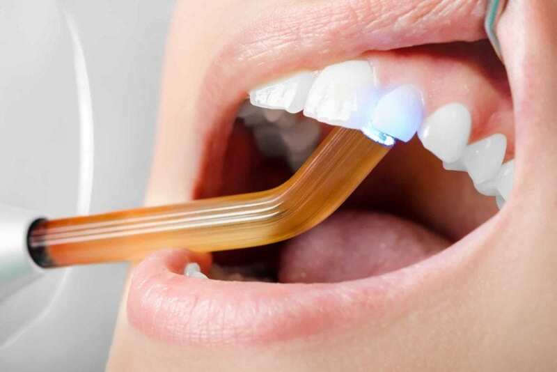Trám răng cửa bị mẻ có đau không? Chi phí bao nhiêu?