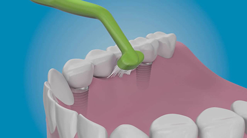 [ Top 4 ] vấn đề bạn nên trao đổi với bác sĩ trước khi trồng răng Implant