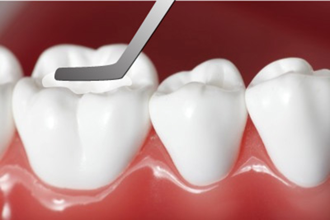 [ Top 7+ ] tác hại của việc trám răng tại nhà và sai cách