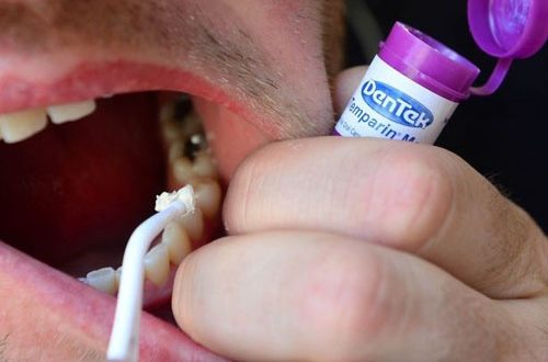 tác hại của việc trám răng4