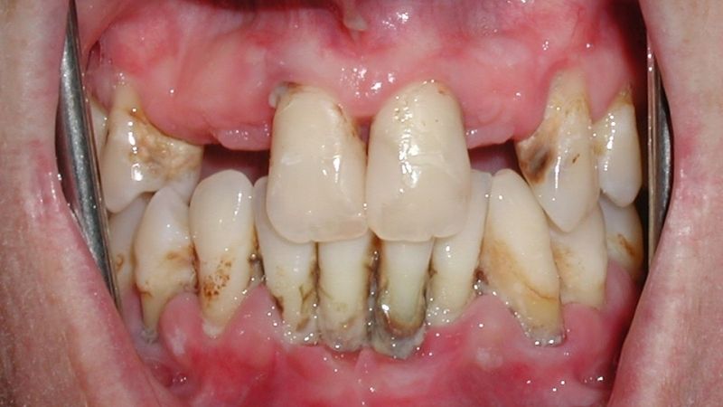 Top 5 bệnh răng miệng ở người cao tuổi thường gặp 6 Bệnh răng miệng người già