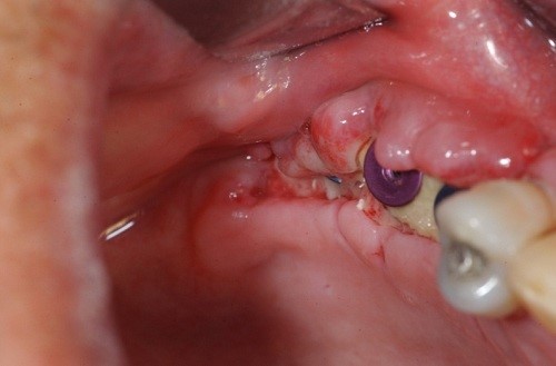 Viêm quanh trụ Implant: Nguyên nhân, Điều trị, Phòng ngừa 5 Viêm quanh trụ Implant: Nguyên nhân, Điều trị, Phòng ngừa