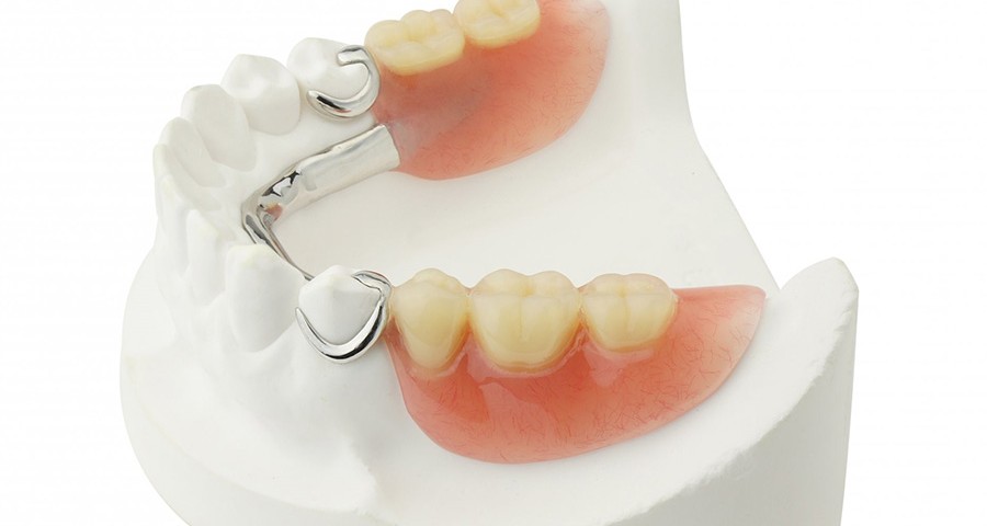 Các loại hàm giả tháo lắp? Ưu nhược điểm của hàm giả tháo lắp? 11 g