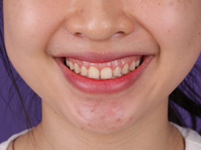 Cười hở lợi: Nguyên nhân, cách điều trị
