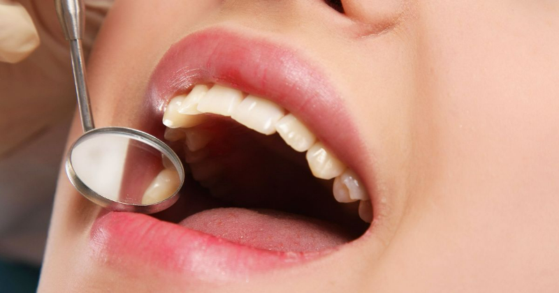 Nhổ răng không trồng lại có sao không