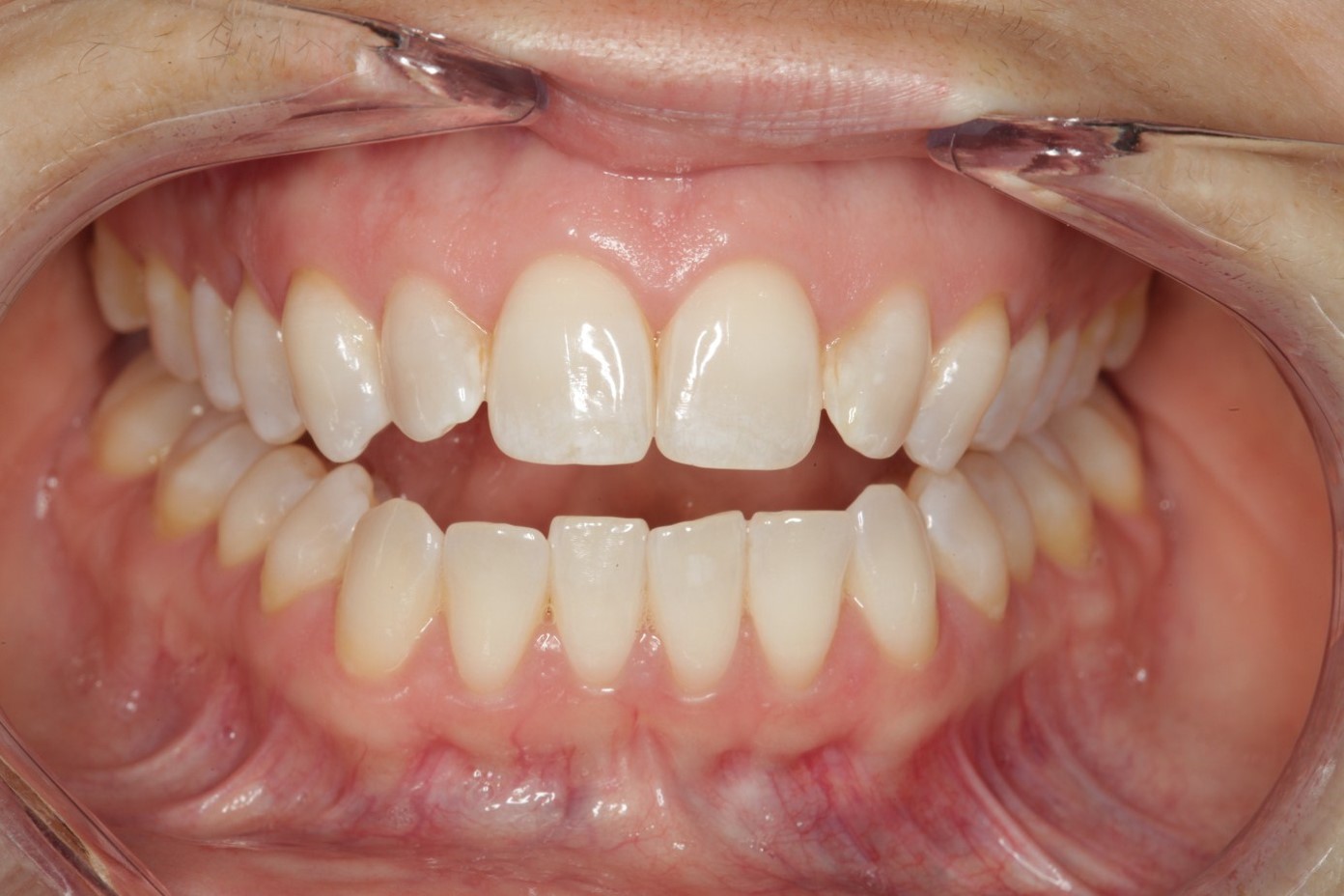 Khớp cắn hở: Nguyên nhân, Tác hại, Cách điều trị