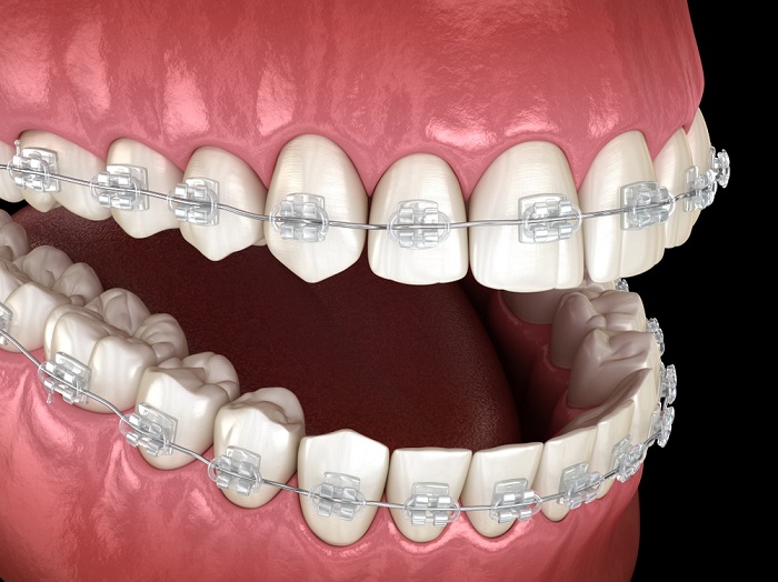 Khớp cắn hở: Nguyên nhân, Tác hại, Cách điều trị