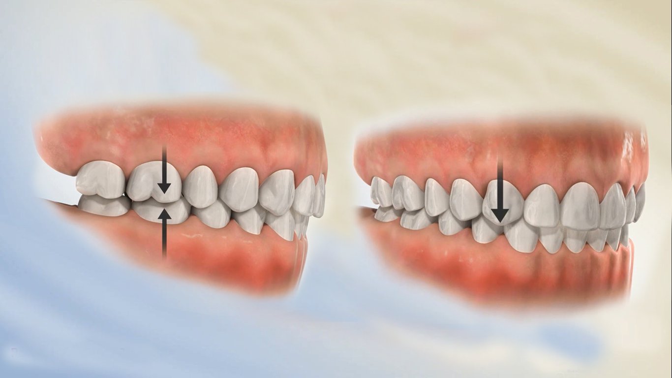 Răng lệch khớp cắn: Nguyên nhân, Tác hại, Cách điều trị 7 Răng lệch khớp cắn: Nguyên nhân, Tác hại, Cách điều trị