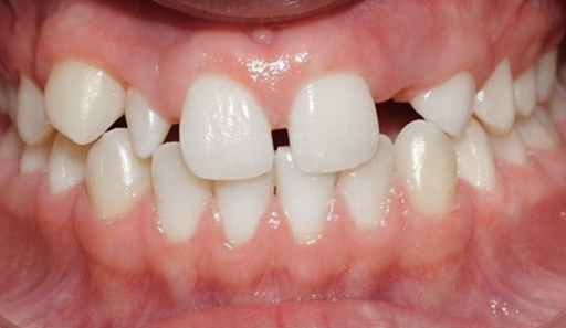 Răng lệch khớp cắn: Nguyên nhân, Tác hại, Cách điều trị 9 Răng lệch khớp cắn: Nguyên nhân, Tác hại, Cách điều trị