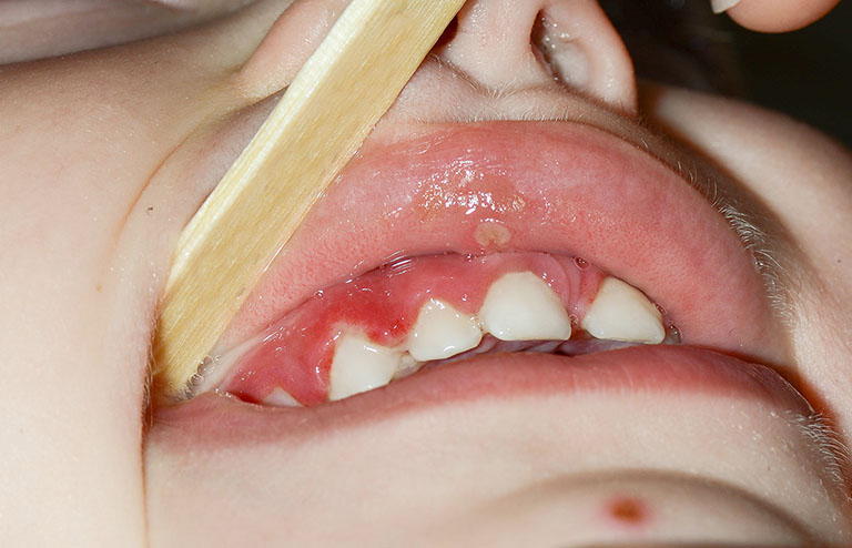 bệnh răng miệng ở trẻ em