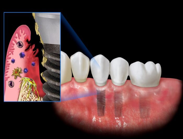 Chảy máu sau khi trồng Implant: Nguyên nhân, cách khắc phục