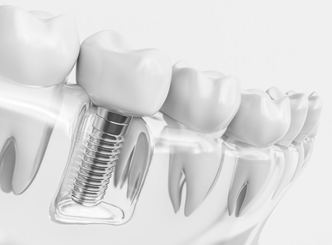 Chảy máu sau khi trồng Implant: Nguyên nhân, cách khắc phục
