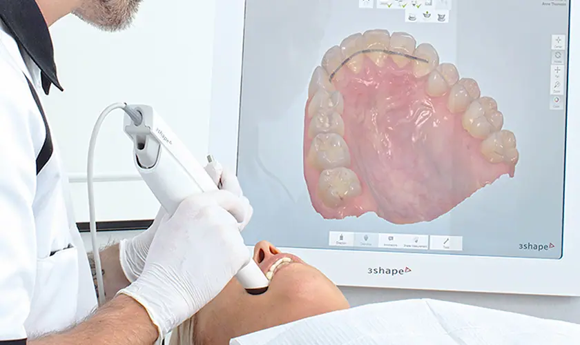 Lấy dấu Implant là gì? Các phương pháp lấy dấu hiện nay?