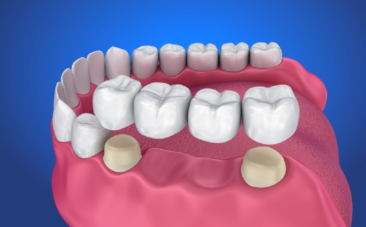 Răng giả bị rơi: Nguyên nhân, Cách xử lý, Cách vệ sinh