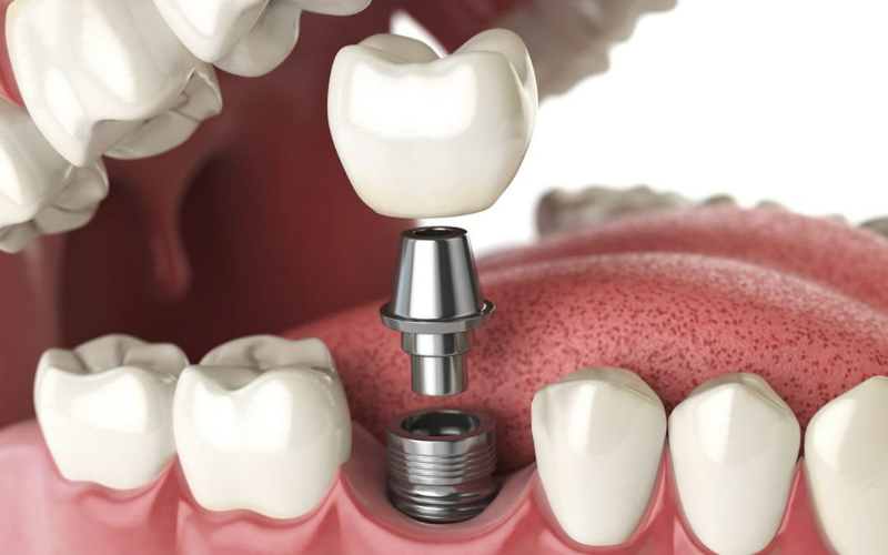 So sánh các loại trụ Implant