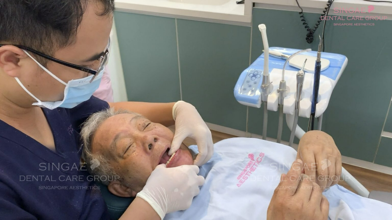 Cấy Implant 3 – 4 tháng sau nhổ răng
