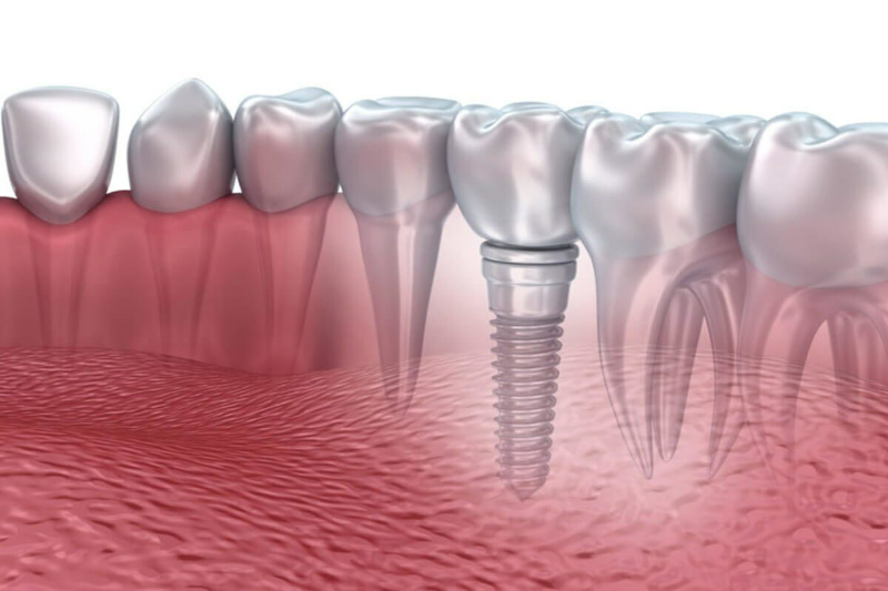 Implant nha khoa