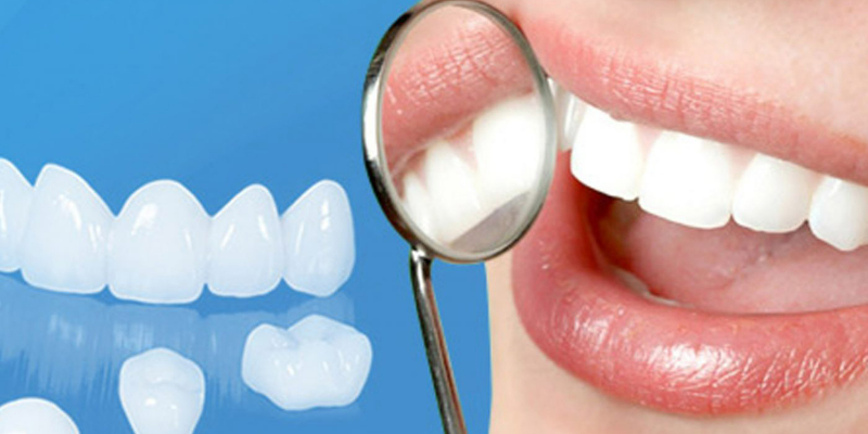 Giá dán sứ Veneer bao nhiêu