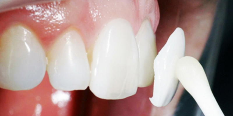 Ưu điểm của phương pháp mặt dán sứ Veneer
