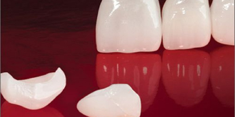 Dán sứ Veneer