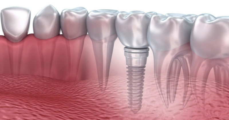 Các loại trụ Implant phổ biến