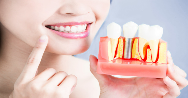 Trồng Implant răng cửa có đau không