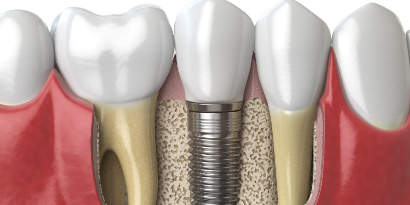 Trồng răng Implant