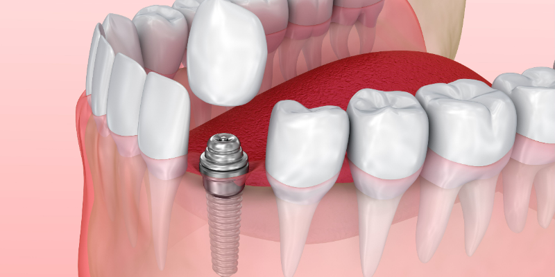 Trồng răng Implant