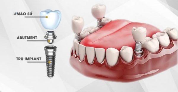 Cấu tạo của Implant