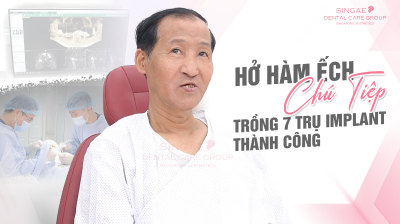 Công nghệ trồng răng Implant SSI là gì? Những ưu điểm cấy ghép Implant 11 Trường hợp trồng răng Implant thành công tại Singae