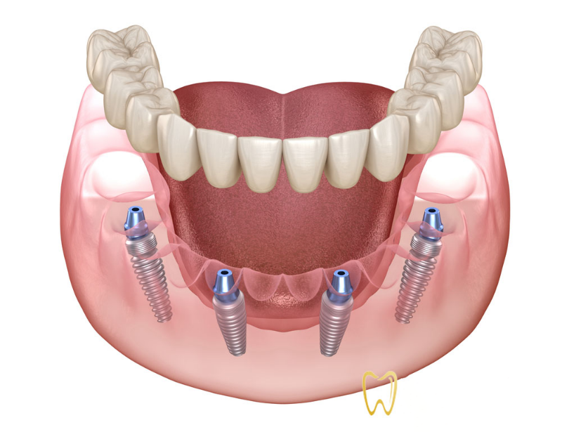 Trồng răng Implant vĩnh viễn có tốt không? Loại trụ Implant nào tốt nhất? Chi phí trồng răng Implant là bao nhiêu? 7 Trồng răng Implant vĩnh viễn bằng kỹ thuật All on 4