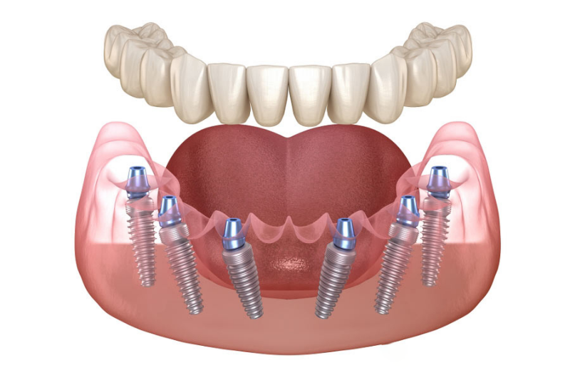 Trồng răng Implant vĩnh viễn có tốt không? Loại trụ Implant nào tốt nhất? Chi phí trồng răng Implant là bao nhiêu? 8 Trồng răng Implant vĩnh viễn bằng kỹ thuật All on 6