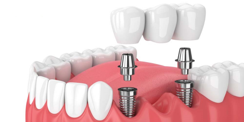 Giá trồng răng Implant trọn gói sẽ phụ thuộc vào một số yếu tố 