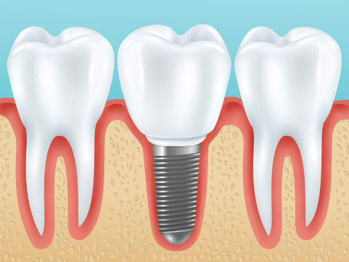 Trường hợp nào nên cấy Implant tức thì? Hiệu quả của phương pháp cấy Implant tức thì 7 Trường hợp nào nên cấy Implant tức thì