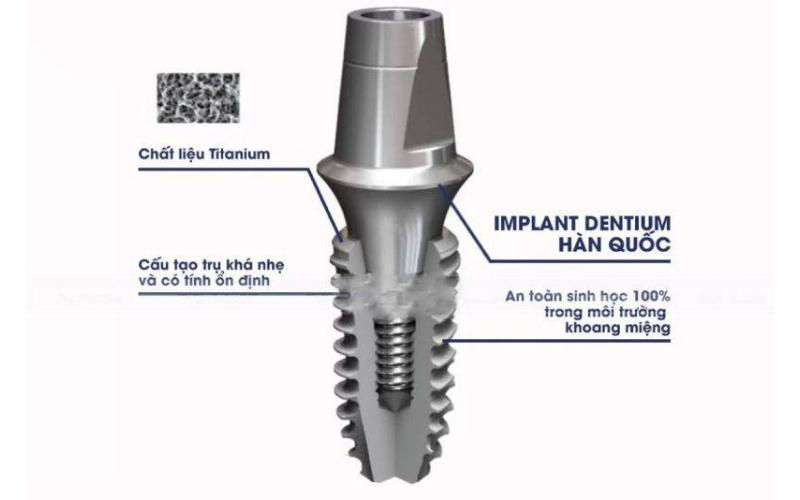 Trồng răng Implant vĩnh viễn có tốt không? Loại trụ Implant nào tốt nhất? Chi phí trồng răng Implant là bao nhiêu? 10 Trụ Dentium Implant Hàn Quốc