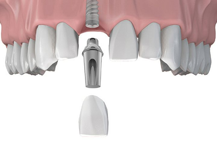 Trường hợp nào nên cấy Implant tức thì? Hiệu quả của phương pháp cấy Implant tức thì 6 Cấy Implant tức thì