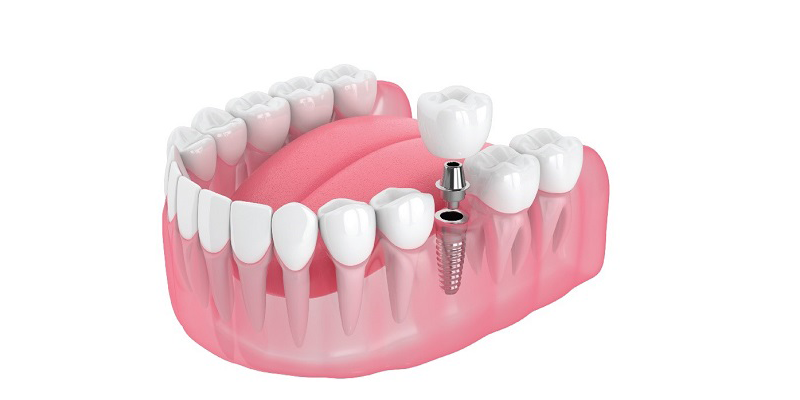 Trường hợp nào nên cấy Implant tức thì? Hiệu quả của phương pháp cấy Implant tức thì 10 Cấy Implant tức thì