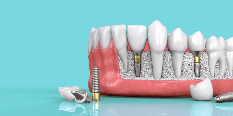 Ưu điểm vượt trội của trồng răng Implant 