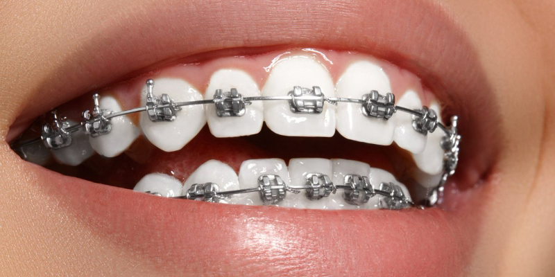 Giải đáp: Niềng răng có được vĩnh viễn không? 4 Niềng răng có được vĩnh viễn không
