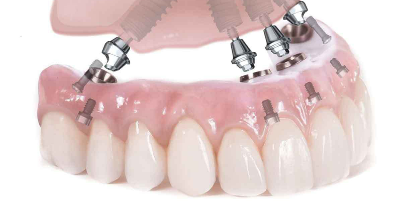 Trồng răng Implant 